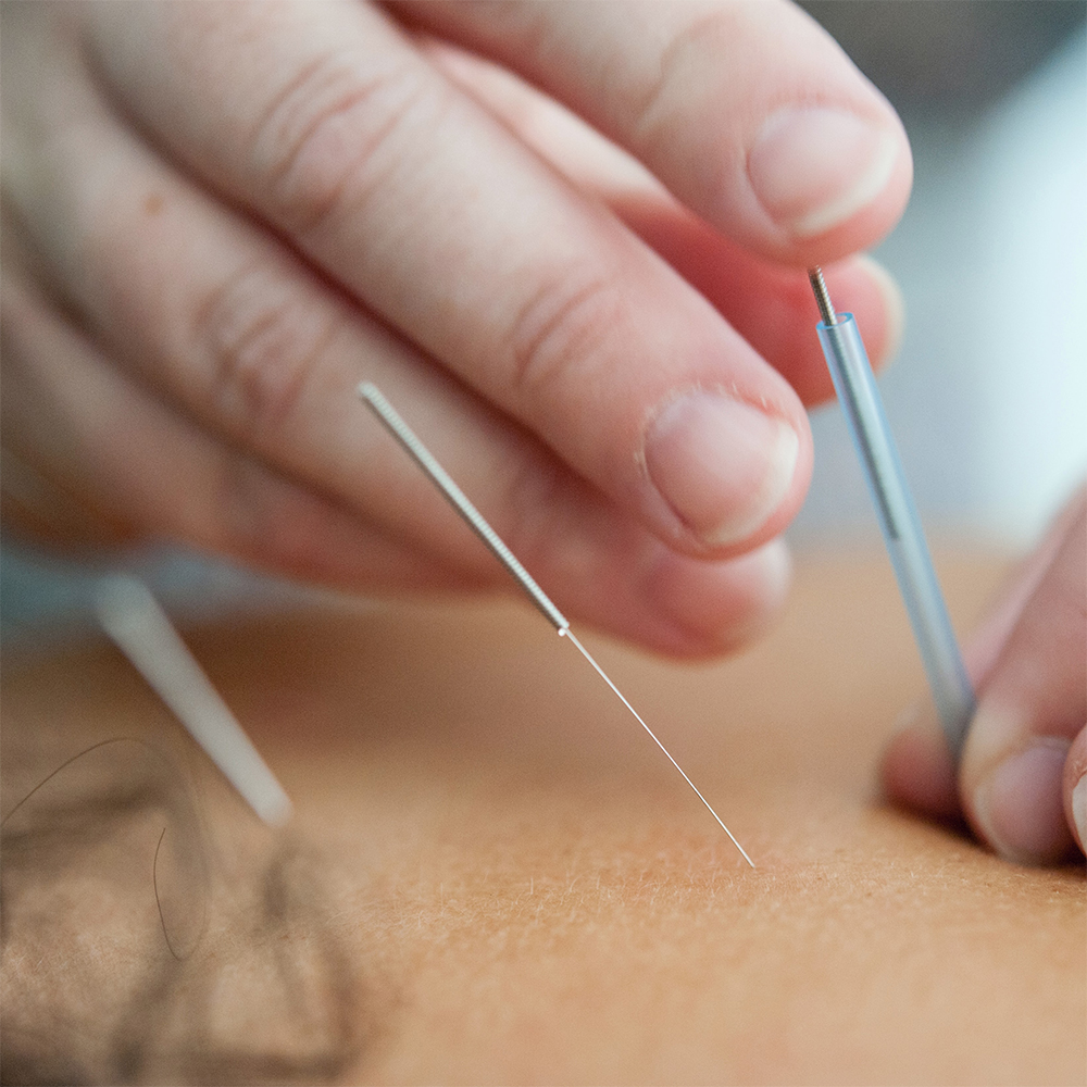 close up shot of hands applying an acupuncture needle -- taken by Katherine Hanlon